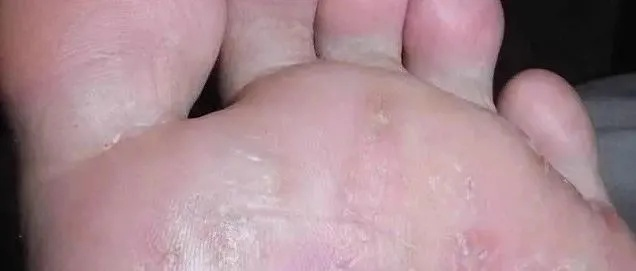 脚底长了像水泡一样的东西很痒什么原因（脚底长了像水泡一样的东西很痒什么原因呢）