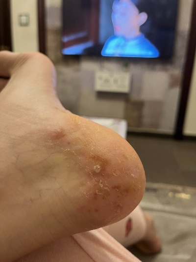 脚上起小水泡还很痒?别忽视,这几种常见原因在作怪 脚上起小水泡还很痒?别忽视,这几种常见原因在作怪